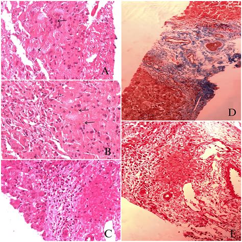 Cureus A Rare Case Of Progressive Familial Intrahepatic Cholestasis