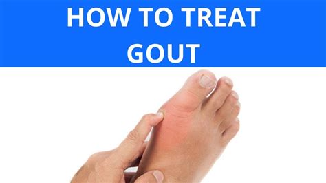 How To Treat Gout Youtube