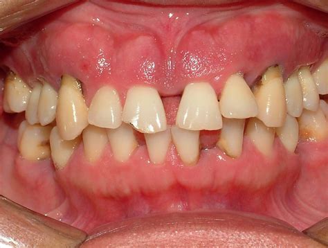 Especialização em Periodontia Casos Clínicos