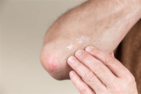 Premium Photo Psoriasis On The Elbow Closeup Dermatitis On Skin Ill