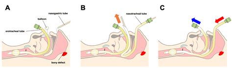Cureus Nasotracheal Intubation After Transsphenoidal Surgery A Case