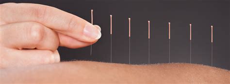 Benefits Of Acupuncture For Back Pain Long Island Spine