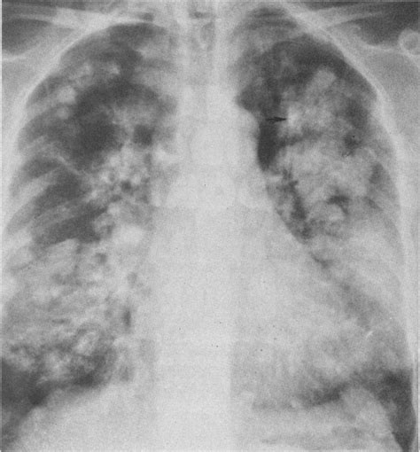 Bilateral Pulmonary Nodules Which Have Increased In Size And Number