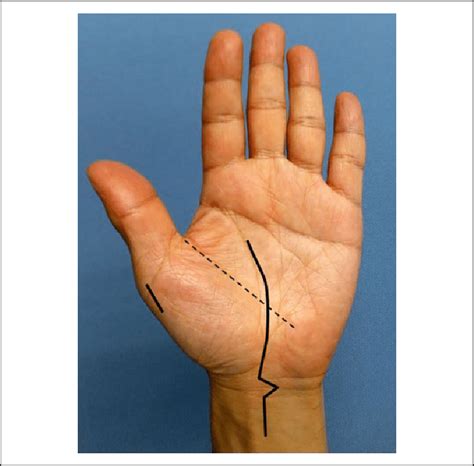 Surgical Skin Incision Length Of The Conventional Camitz Opponensplasty