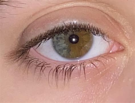Sectoral Heterochromia Green And Light Brown In Both Eyes Reyes