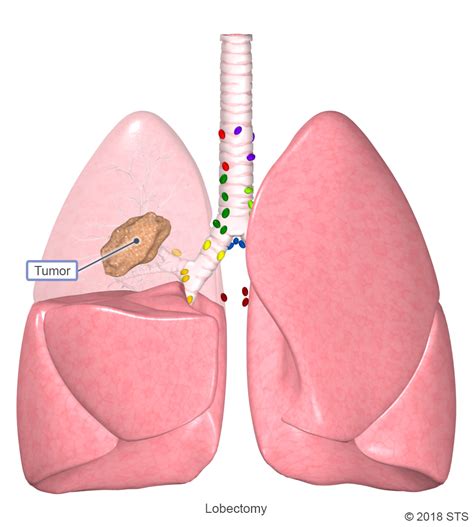 Lung Cancer The Patient Guide To Heart Lung And Esophageal Surgery