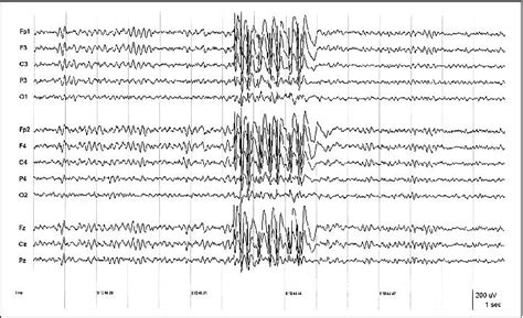 Jle Epileptic Disorders Video‐eeg Evidence Of Lateralized Clinical
