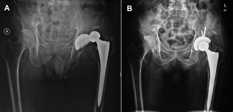 Direct Anterior Approach For Total Hip Arthroplasty In The Lateral