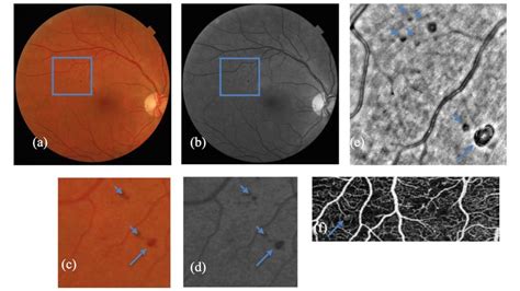 A B Color Fundus Photo And Red Free Photo Of A Patient With