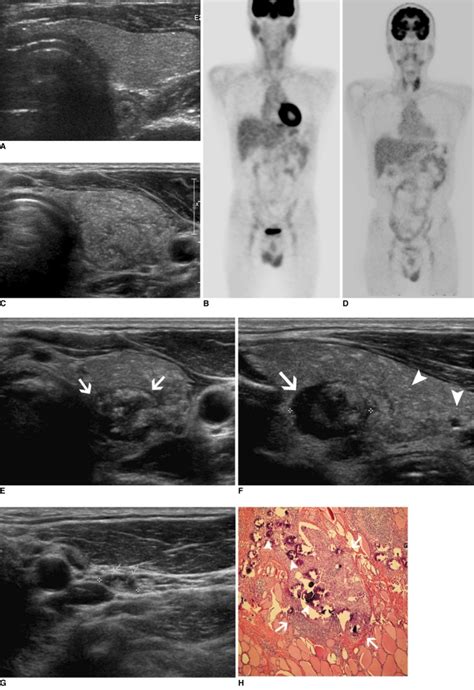 Diffuse Sclerosing Variant Of Papillary Thyroid Carcinoma In