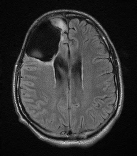 Brain Tumor In Temporal Lobe Buyxraysonline