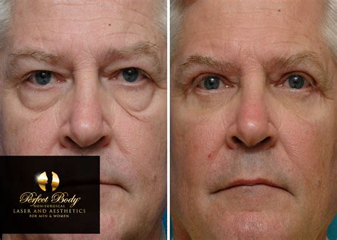 Ultherapy Laser Skin Tightening For The Face Perfect Body Laser