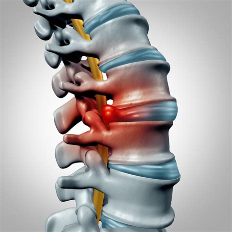 Bulging Disc Disorder And Treatment Nj North Jersey Spine Group