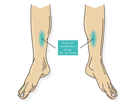 Shin Splints Causes Symptoms And Treatment The Foot Hub
