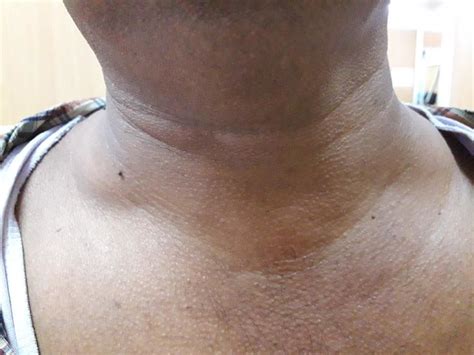 Swollen Lymph Nodes In Collarbone Area