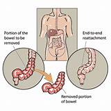 Sigmoid Colon Removal Recovery Photos