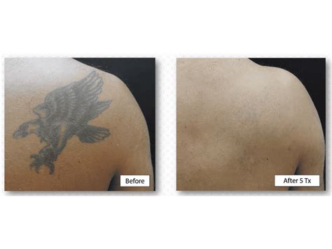 Laser Tattoo Removal Aesthetic Lasers Business Education