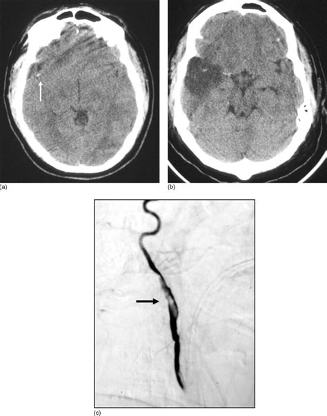 Imaging Of Blunt Cerebrovascular Injuries European Journal Of Radiology