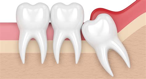Wisdom Tooth Pain Causes And Cures Vienna Clinic