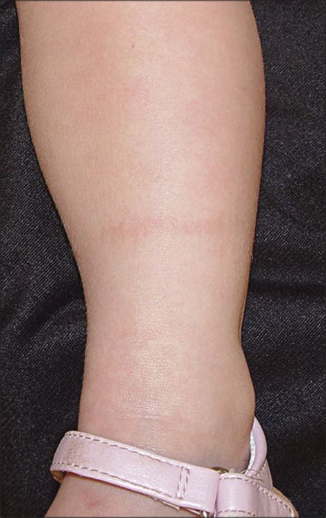 Sock Line Hyperpigmentation Case Series And Literature Review