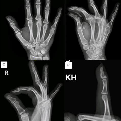 Preoperative Radiographs Of The Right Hand A Ap View B Lateral