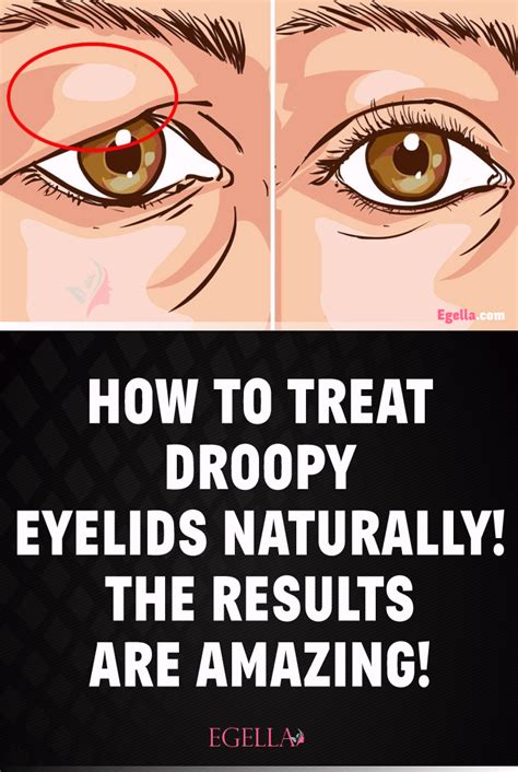 How To Treat Droopy Eyelids Naturally The Results Are Amazing In 2021