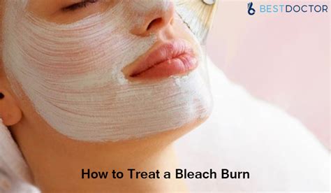 How Long Do Bleach Burns Last Bleach Burn On Face Hands Fingers