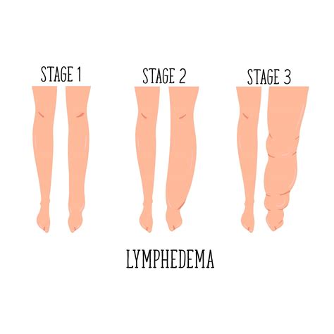 Le Lymphœdème Causes Symptômes Et Traitements