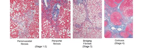 Representative Images Of Liver Histology Showing Stages Of Fibrosis