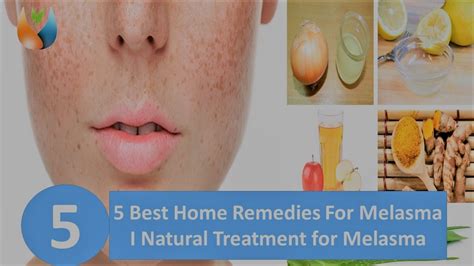 5 Best Home Remedies For Melasma I Natural Treatment For Melasma Youtube