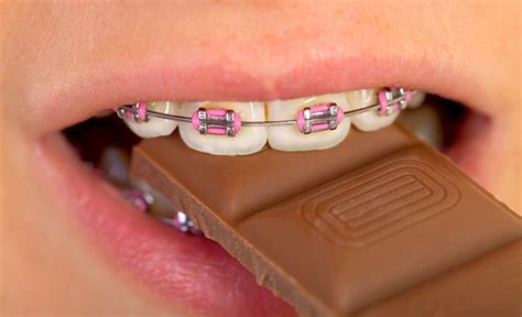 what foods can you not eat with braces uk erasmo matney