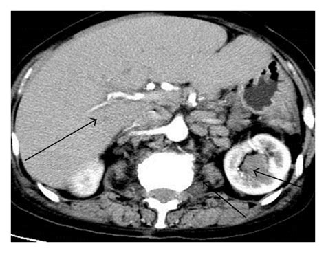 Ct Result Shows Multiple Lymph Nodes In The Peritoneal Cavity And
