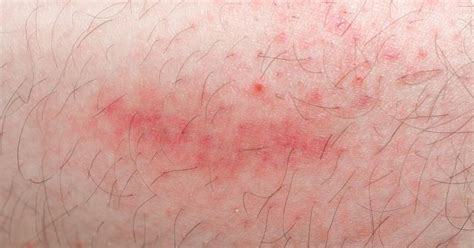 How To Get Rid Of An Allergic Reaction Rash Livestrongcom