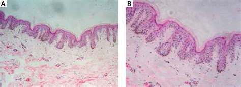 Progressive Cribriform And Zosteriform Hyperpigmentation A Histologic