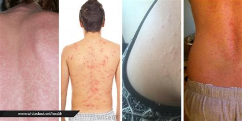 How To Get Rid Of Itchy Back Rashes Whitedust