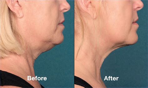 Kybella Treatment Age Perfectly