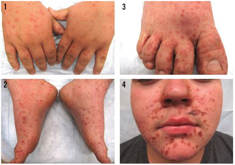 An Adolescents Exuberant Rash Is It Hand Foot And Mouth Disease