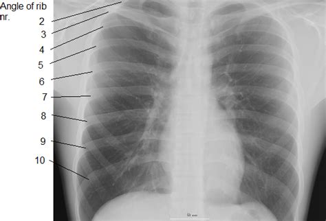What organs are on the left side of the rib? File:Ribs labeled.png - Wikipedia