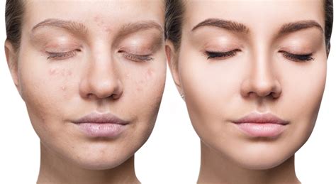 Acne Treatments Skinshine Medspa