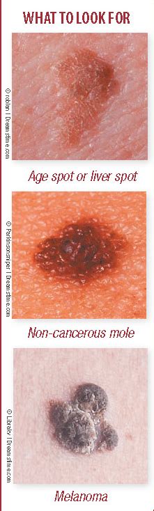 How To Tell If That Spot May Be Skin Cancer Sense Of Urgency