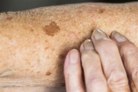 Liver Spots Symptoms Causes Treatment