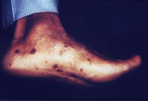 Image Syphilis—secondary Soles Msd诊疗手册专业版