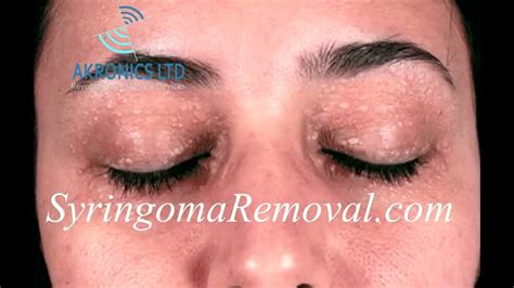 Syringoma Removal At Home Youtube