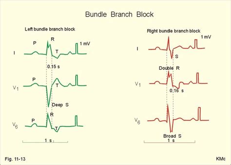 Bundle Branch Block Wecare Germany