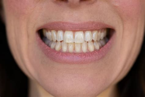 Whitening Teeth Gel Teeth Whiteners And Teeth Bleaching Kits