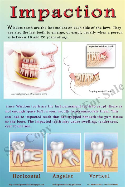 Dental Posters To Educate Patients Impaction