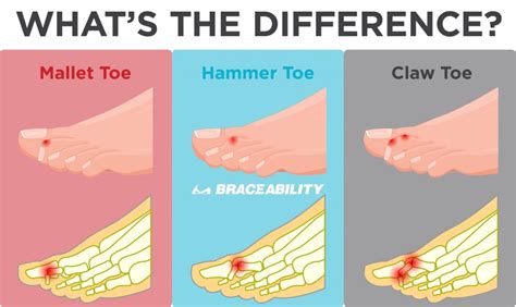 What Are The Symptoms And Causes Of Hammers Toe And Mallet Toe
