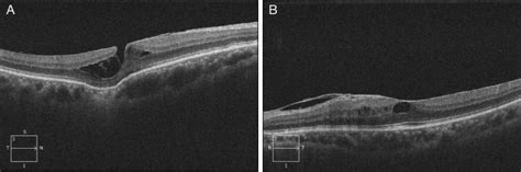 Focal Choroidal Excavation With Foveoschisis Canadian Journal Of
