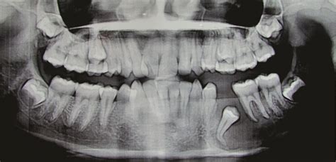Marsupialisation A Treatment Modality Of A Dentigerous Cyst Bmj Case