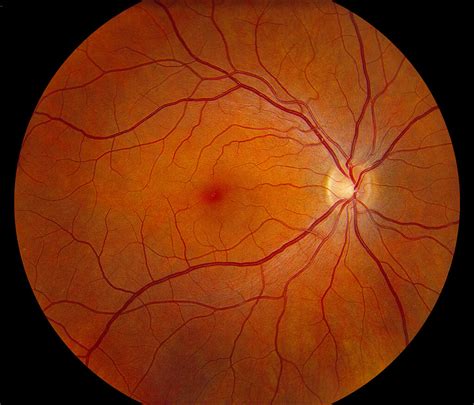 A Detailed Study On Cystoid Macular Oedema Diagnosis Treatment